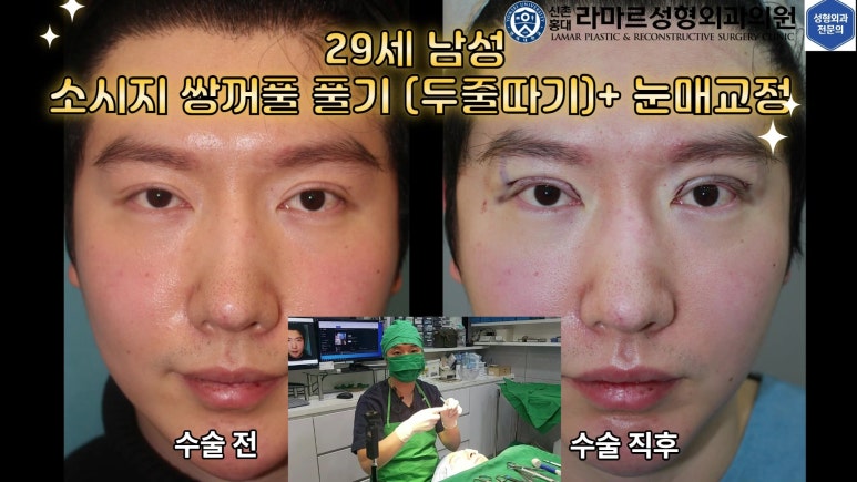 29세 남자, 소시지 쌍꺼풀 두줄따기로 낮추기 (쌍꺼풀 재수술) 관련 이미지 5