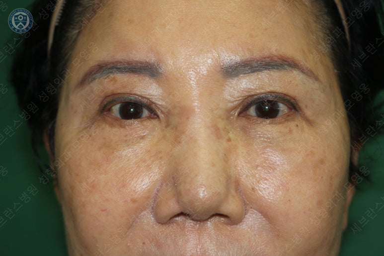 71세 여성, 이마거상술과 이마축소술 (71/F, Forehead lift and reduction) 관련 이미지 30