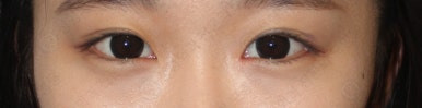 17세 여성, 쌍꺼풀+앞트임(DEO+Medial epicanthoplasty) 관련 이미지 53