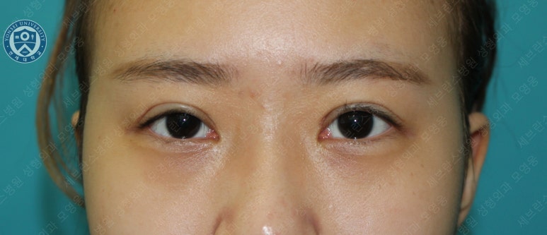 17세 여성, 비절개 눈매교정 및 앞트임 재수술 (17/F NI ptosis correction & Med. epicanthoplasty revision) 증례 관련 이미지 11