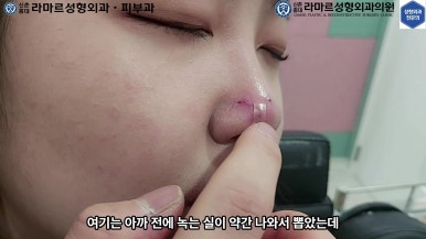 21세 여성 코 지름 1cm 점 제거수술 : 나선피판술(Spiral Flap) 수술전~5달 경과. (+쌍꺼풀수술, 코필러) 관련 이미지 66