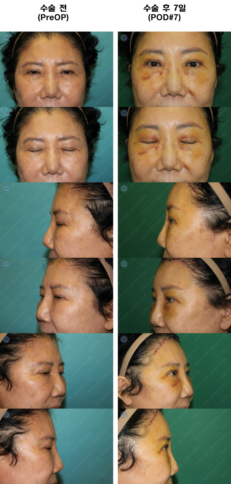 71세 여성, 이마거상술과 이마축소술 (71/F, Forehead lift and reduction) 관련 이미지 55