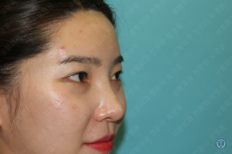 28세 여성 두줄따기, 눈밑지(28/F D.E.O & transconjunctival septal fat redraping) 관련 이미지 8