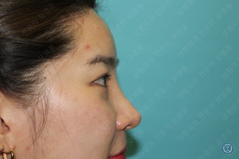 28세 여성 두줄따기, 눈밑지(28/F D.E.O & transconjunctival septal fat redraping) 관련 이미지 9