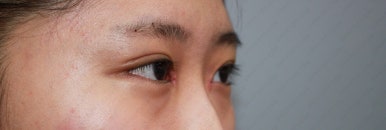 17세 여성, 쌍꺼풀+앞트임(DEO+Medial epicanthoplasty) 관련 이미지 19