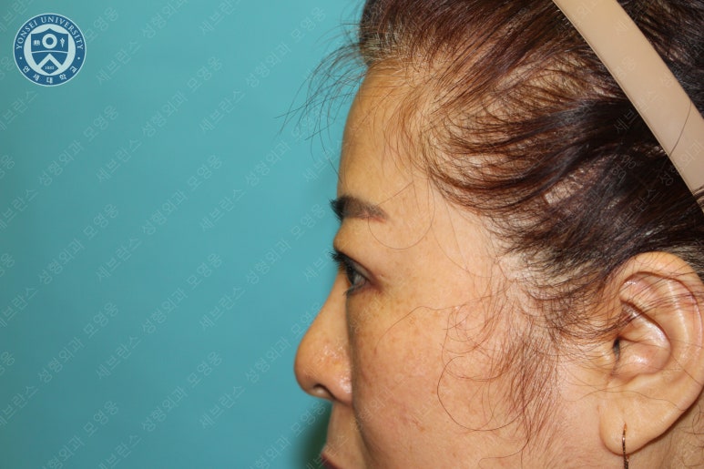 60세 여성, 상안검 및 하안검 성형술 증례 (60/F Upper & lower blepharoplasty) 관련 이미지 19