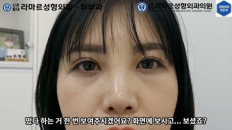 30대 여성 "쌍꺼풀+눈매교정" 상담, 디자인, 수술 전체 과정, 결과, 경과 모두 공개합니다. 관련 이미지 57