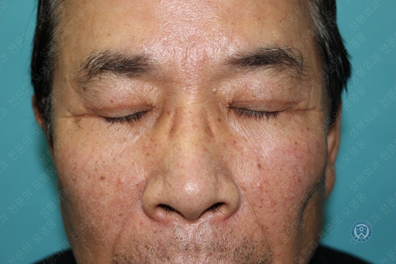 67세 남성, 상&middot;하안검성형술 및 안검하수교정 (67/M, Upper &  lower blepharoplasty with ptosis correction) 관련 이미지 38