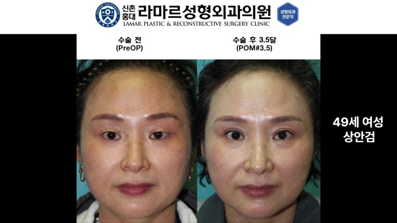 40대~80대 눈 수술 케이스 : 상안검성형술 전후 사진 모음 관련 이미지 9