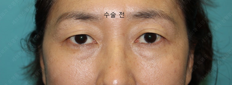 55세 여성, 상안검 및 하안검 성형술 증례 (55/F Upper & lower blepharoplasty) 관련 이미지 2