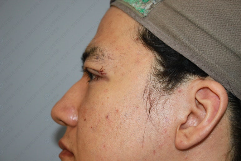 27세 남성 무쌍(속쌍)눈매교정 (27/M Ptosis correction with double lid plasty) 관련 이미지 17
