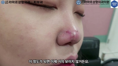 21세 여성 코 지름 1cm 점 제거수술 : 나선피판술(Spiral Flap) 수술전~5달 경과. (+쌍꺼풀수술, 코필러) 관련 이미지 68