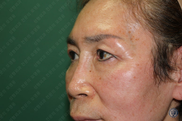 64세 여성 상안검성형술+눈매교정 (64/F Upper blepharoplasty with ptosis correction) 관련 이미지 39