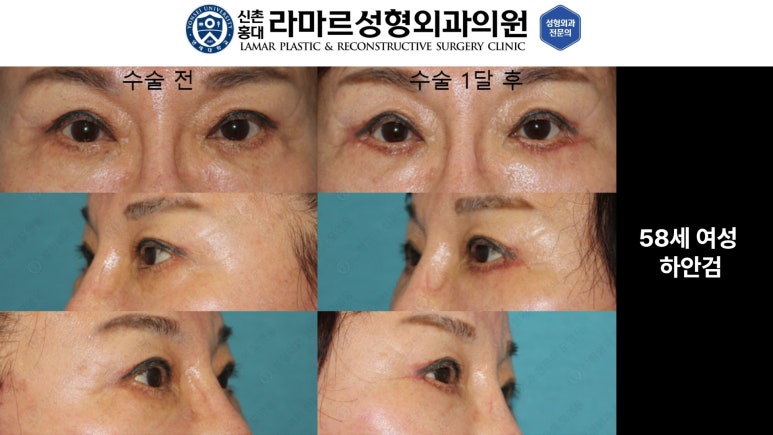 30대~80대 눈 수술 케이스 : 하안검성형술 전후 사진 모음 관련 이미지 25