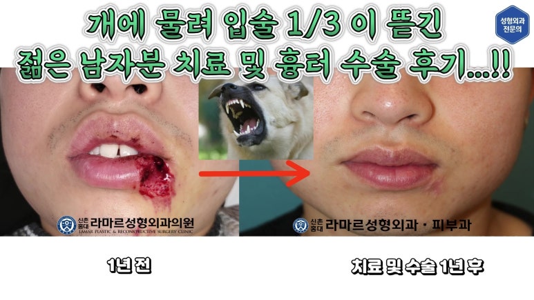 개에 물려 입술 1/3이 뜯긴 19세 남자분 치료 및 흉터 성형수술& 레이저 후기....! 관련 이미지 5