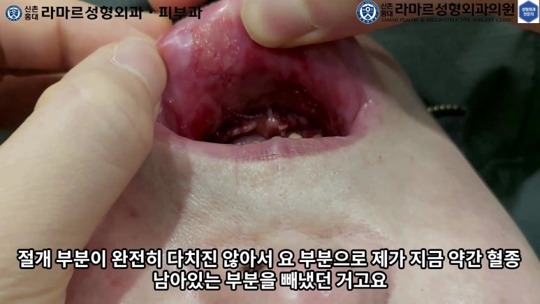 파라핀 필러 입 안 절개로 흉터없이 빼내기! 관련 이미지 109