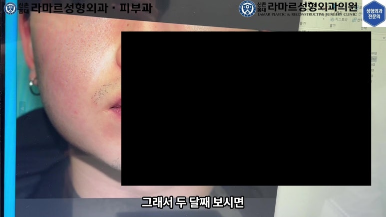 개에 물려 입술 1/3이 뜯긴 19세 남자분 치료 및 흉터 성형수술& 레이저 후기....! 관련 이미지 33