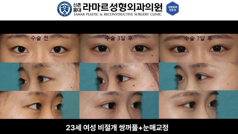 10대~30대 눈 수술 케이스 : 대표원장님 쌍꺼풀 전후 사진 모음 관련 이미지 21