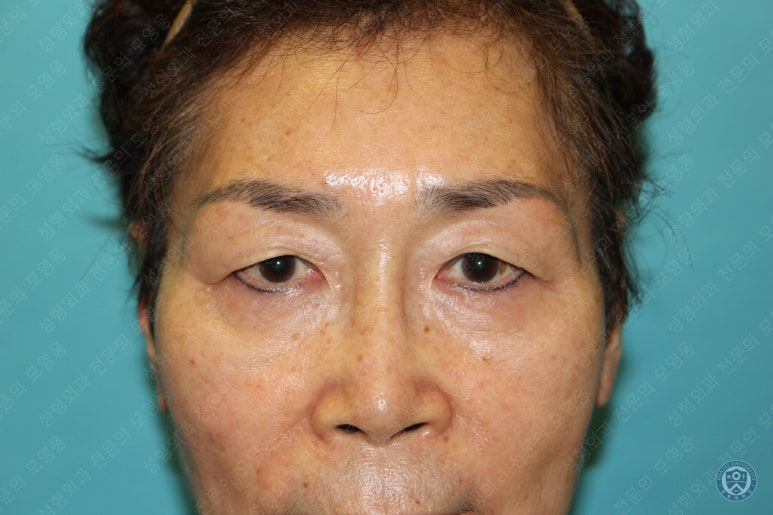 64세 여성 상안검성형술+눈매교정 (64/F Upper blepharoplasty with ptosis correction) 관련 이미지 3