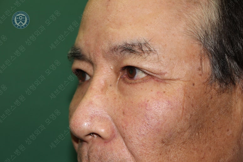 67세 남성, 상&middot;하안검성형술 및 안검하수교정 (67/M, Upper &  lower blepharoplasty with ptosis correction) 관련 이미지 33