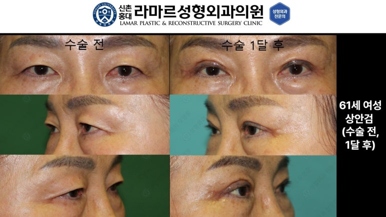 40대~80대 눈 수술 케이스 : 상안검성형술 전후 사진 모음 관련 이미지 25