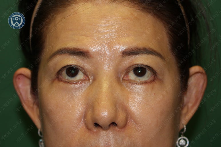 59세 여성, 그레이브스 안병증이 있는 돌출눈 중년 여성 하안검 성형술 (Lower blepharoplasty in Graves 관련 이미지 20