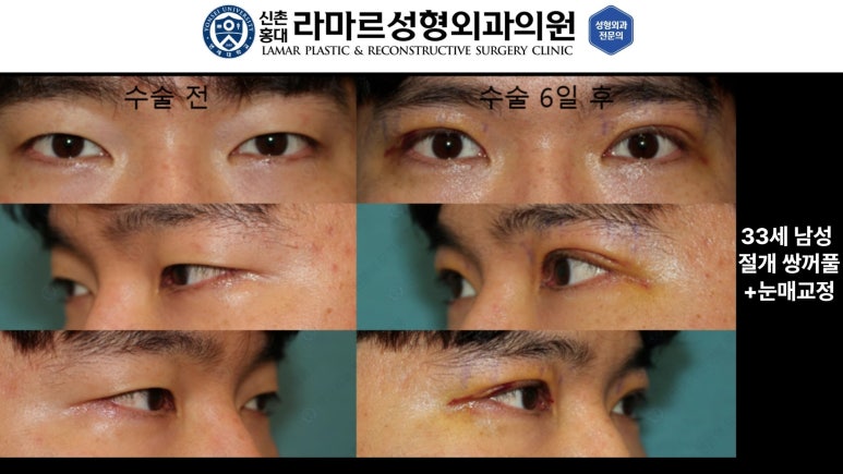 10대~30대 눈 수술 케이스 : 대표원장님 쌍꺼풀 전후 사진 모음 관련 이미지 15