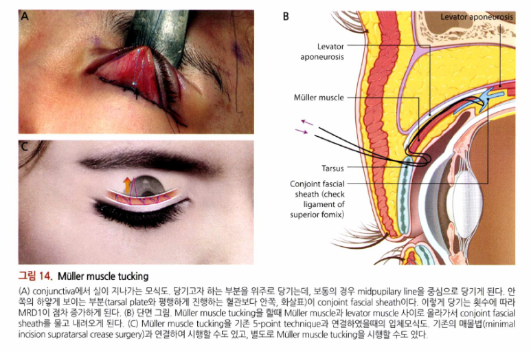 17세 여성, 비절개 눈매교정 및 앞트임 재수술 (17/F NI ptosis correction & Med. epicanthoplasty revision) 증례 관련 이미지 8