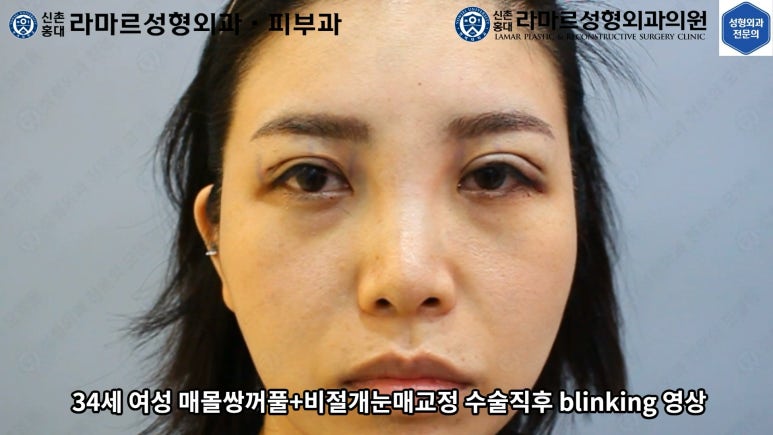 30대 여성 "쌍꺼풀+눈매교정" 상담, 디자인, 수술 전체 과정, 결과, 경과 모두 공개합니다. 관련 이미지 41