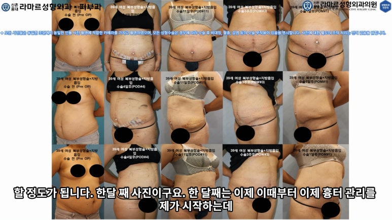 '복부성형술+지방흡입(Abdominoplasty+PAL)' 으로 뱃살 끝장내기! 관련 이미지 50