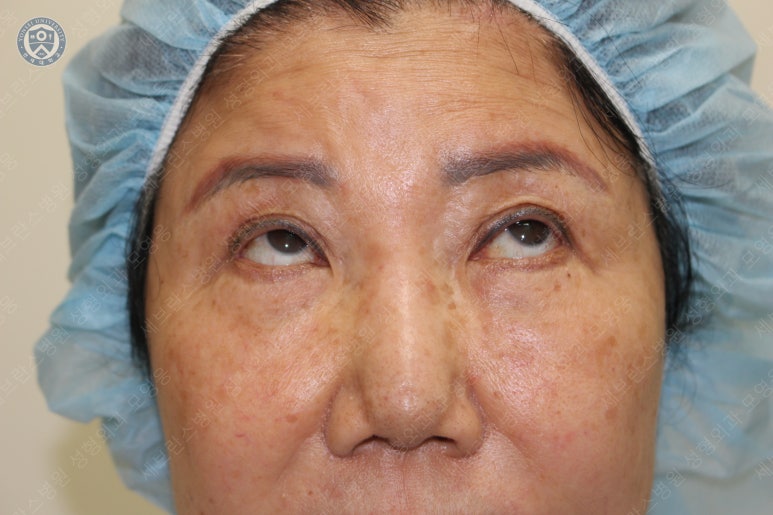 71세 여성, 이마거상술과 이마축소술 (71/F, Forehead lift and reduction) 관련 이미지 14