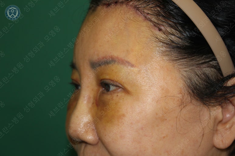 71세 여성, 이마거상술과 이마축소술 (71/F, Forehead lift and reduction) 관련 이미지 25