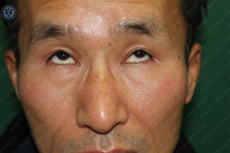 남자눈성형: 무쌍눈매교정 (Blephroptosis correction-levator aponeurosis advancement) 관련 이미지 40