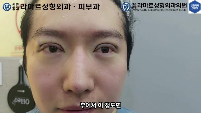 29세 남자, 소시지 쌍꺼풀 두줄따기로 낮추기 (쌍꺼풀 재수술) 관련 이미지 65