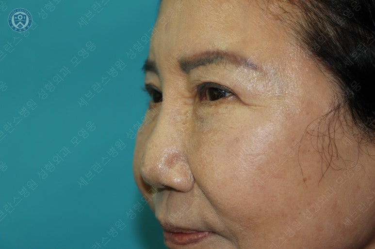 71세 여성, 이마거상술과 이마축소술 (71/F, Forehead lift and reduction) 관련 이미지 45