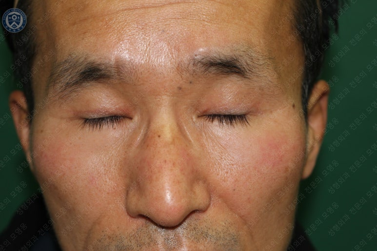 남자눈성형: 무쌍눈매교정 (Blephroptosis correction-levator aponeurosis advancement) 관련 이미지 39