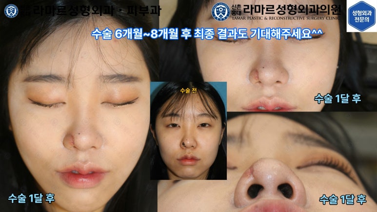 지름 1cm 코 점 제거수술 : 나선피판술(Spiral Flap) 수술전~1달 경과. (Feat. 턱끝필러+사각턱 보톡스) 관련 이미지 183