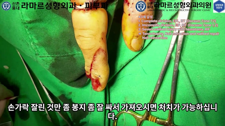 손가락 힘줄 손상 및 열상, 손톱 바닥 열상 처치 (Extensor tendon repair and nailbed injury treatment) 관련 이미지 19