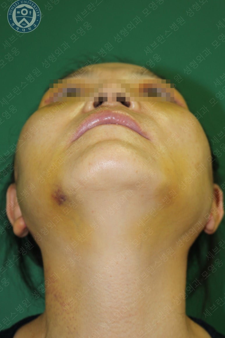 55세 여성, 이중평면 안면거상(55/F, Dual-plane full facelift) 관련 이미지 22