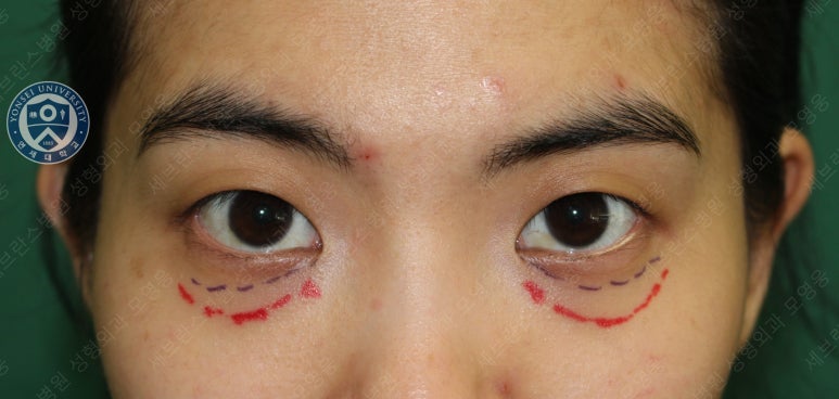 28세 여성, 눈밑지방재배치(눈밑지, 28/F Transconjunctival septal fat redraping-internal fixation technique) 관련 이미지 14
