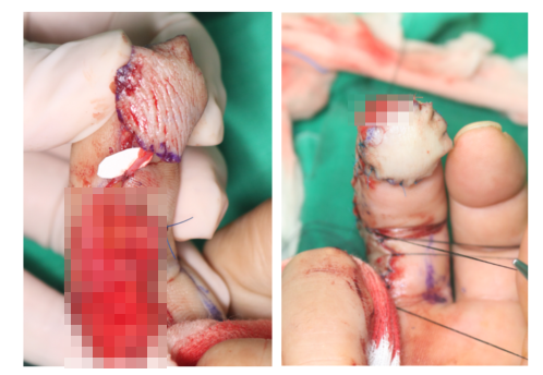수지 말단부 절단에 시행한 동측 역행성 유경피판술 증례 (Homodigital Reverse Island Flap for Fingertip Amputation) 관련 이미지 8