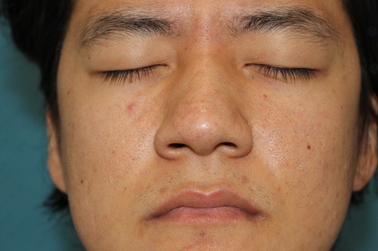 27세 남성 무쌍(속쌍)눈매교정 (27/M Ptosis correction with double lid plasty) 관련 이미지 7