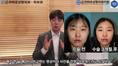 21세 여성 코 지름 1cm 점 제거수술 : 나선피판술(Spiral Flap) 수술전~5달 경과. (+쌍꺼풀수술, 코필러) 관련 이미지 64