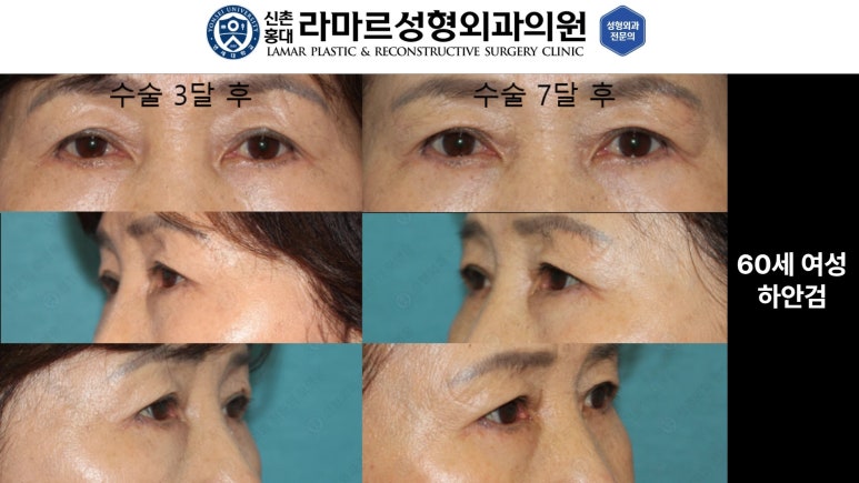 30대~80대 눈 수술 케이스 : 하안검성형술 전후 사진 모음 관련 이미지 24