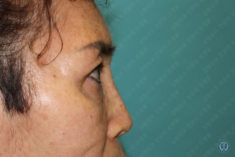 64세 여성 상안검성형술+눈매교정 (64/F Upper blepharoplasty with ptosis correction) 관련 이미지 33