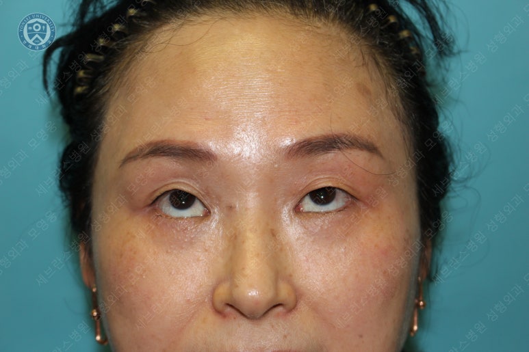 49세 여성, 토안이 있는 중년여성의 상안검성형술 (49/F, Upper blepharoplasty with lagophthalmos correction& LP) 관련 이미지 5