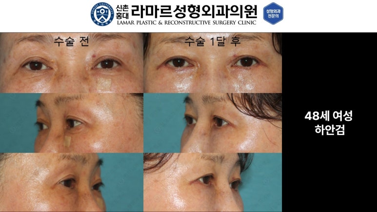 30대~80대 눈 수술 케이스 : 하안검성형술 전후 사진 모음 관련 이미지 7