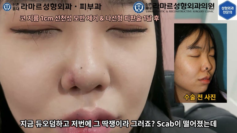 지름 1cm 코 점 제거수술 : 나선피판술(Spiral Flap) 수술전~1달 경과. (Feat. 턱끝필러+사각턱 보톡스) 관련 이미지 155