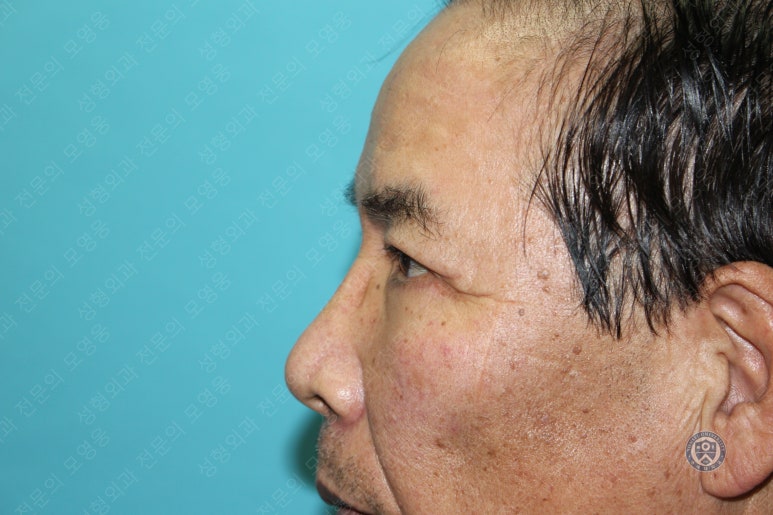 67세 남성, 상&middot;하안검성형술 및 안검하수교정 (67/M, Upper &  lower blepharoplasty with ptosis correction) 관련 이미지 40