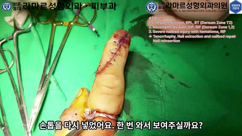 손가락 힘줄 손상 및 열상, 손톱 바닥 열상 처치 (Extensor tendon repair and nailbed injury treatment) 관련 이미지 29